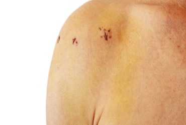 Artroscopia de hombro