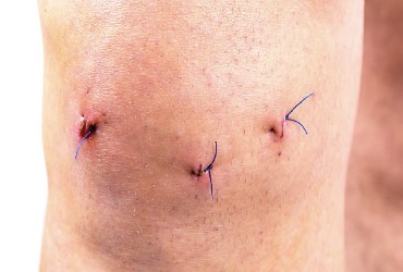 Artroscopia de rodilla