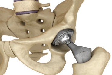 Prótesis de cadera